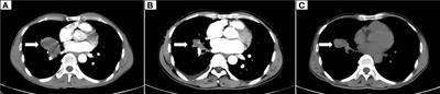 EML4-ALK rearrangement in primary malignant fibrous histiocytoma of the lung treated with alectinib: A case report